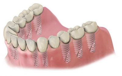 Milyen implantátumot használunk a fogbeültetés során?